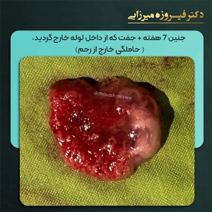 حاملگی-مولار-26
