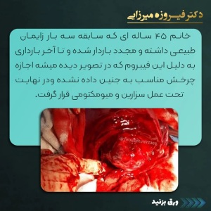 سزارین-و-میومکتومی-8