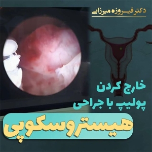 هیستروسکوپی-24