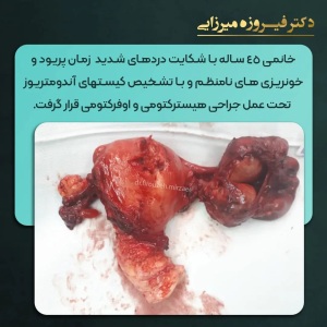 هیسترکتومی-اوفرکتومی-16