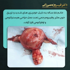 هیسترکتومی-اوفرکتومی-17