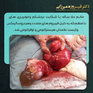 هیسترکتومی-اوفرکتومی-18