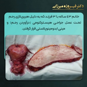 هیسترکتومی-مینی-ابدومینوپلاستی-21