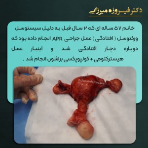 هیسترکتومی-کولپوپکسی-19