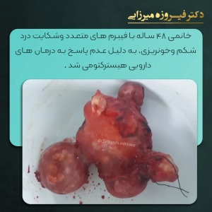 هیسترکتومی-10