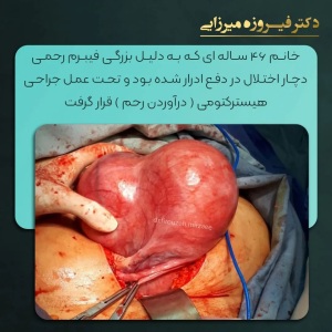 هیسترکتومی-11