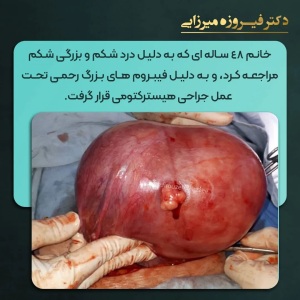 هیسترکتومی-14