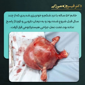 هیسترکتومی-15