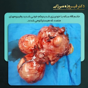 هیسترکتومی-20