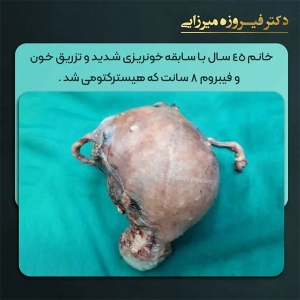 هیسترکتومی-22