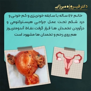هیسترکتومی-25