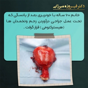 هیسترکتومی-27