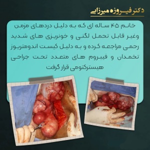 هیسترکتومی-5