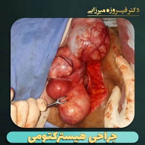 هیسترکتومی-6
