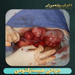 هیسترکتومی-7