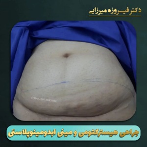 هیسترکتوپی-و-مینی-ابدومینوپلاستی-1