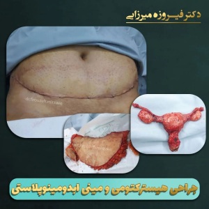 هیسترکتوپی-و-مینی-ابدومینوپلاستی-2