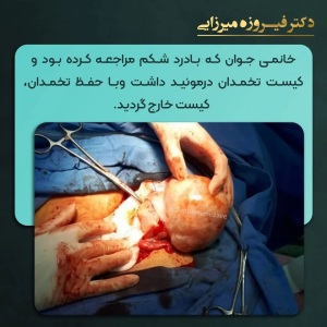 کیست-تخمدان-درموئید-13