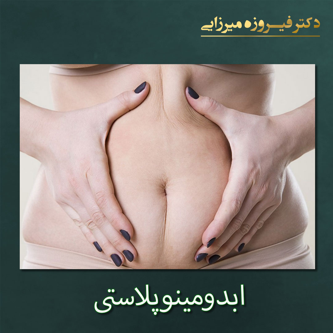 ابدومینوپلاستی - دکتر فیروزه میرزایی