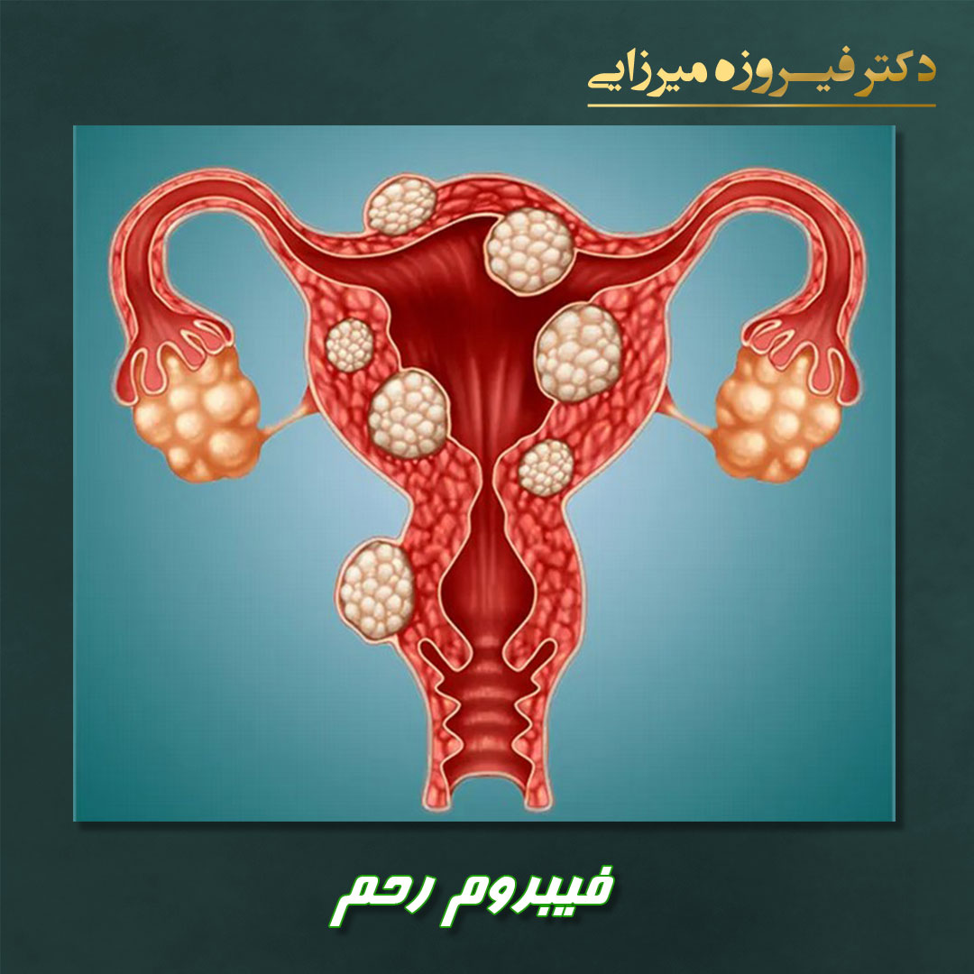 فیبروم رحم - دکتر فیروزه میرزایی