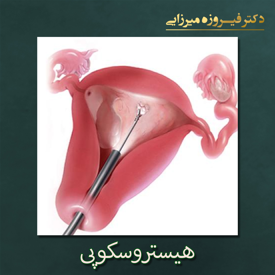 هیستروسکوپی - دکتر فیروزه میرزایی