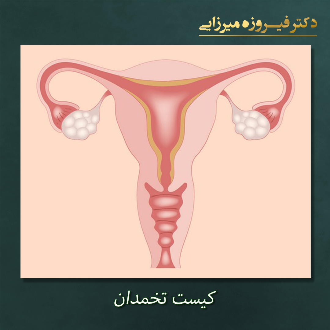 کیست تخمدان - دکتر فیروزه میرزایی