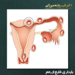 بارداری خارج از رحم