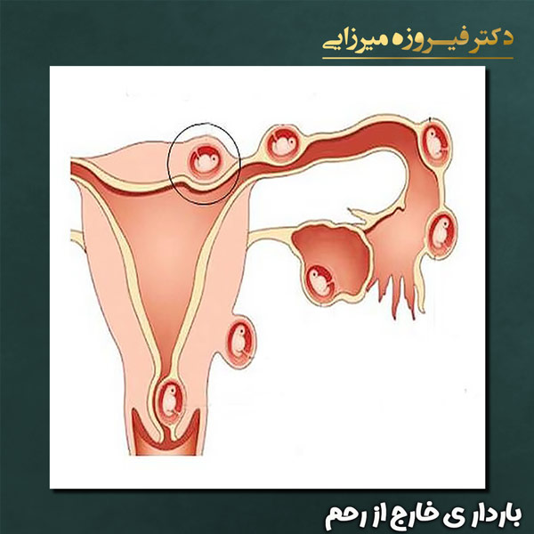 لوله های رحم ، تخمدان ها را به هم متصل می کند قرار نگرفتن تخمک های بارور شده در لوله های تخمدان به سمت رحم ، حاملگی لوله ای یا خارج از رحم را برای مادر به وجود می آورد.