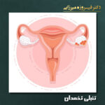 تنبلی تخمدان