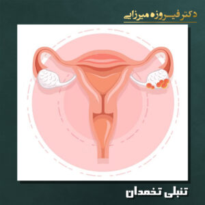 تنبلی تخمدان - دکتر میرزایی