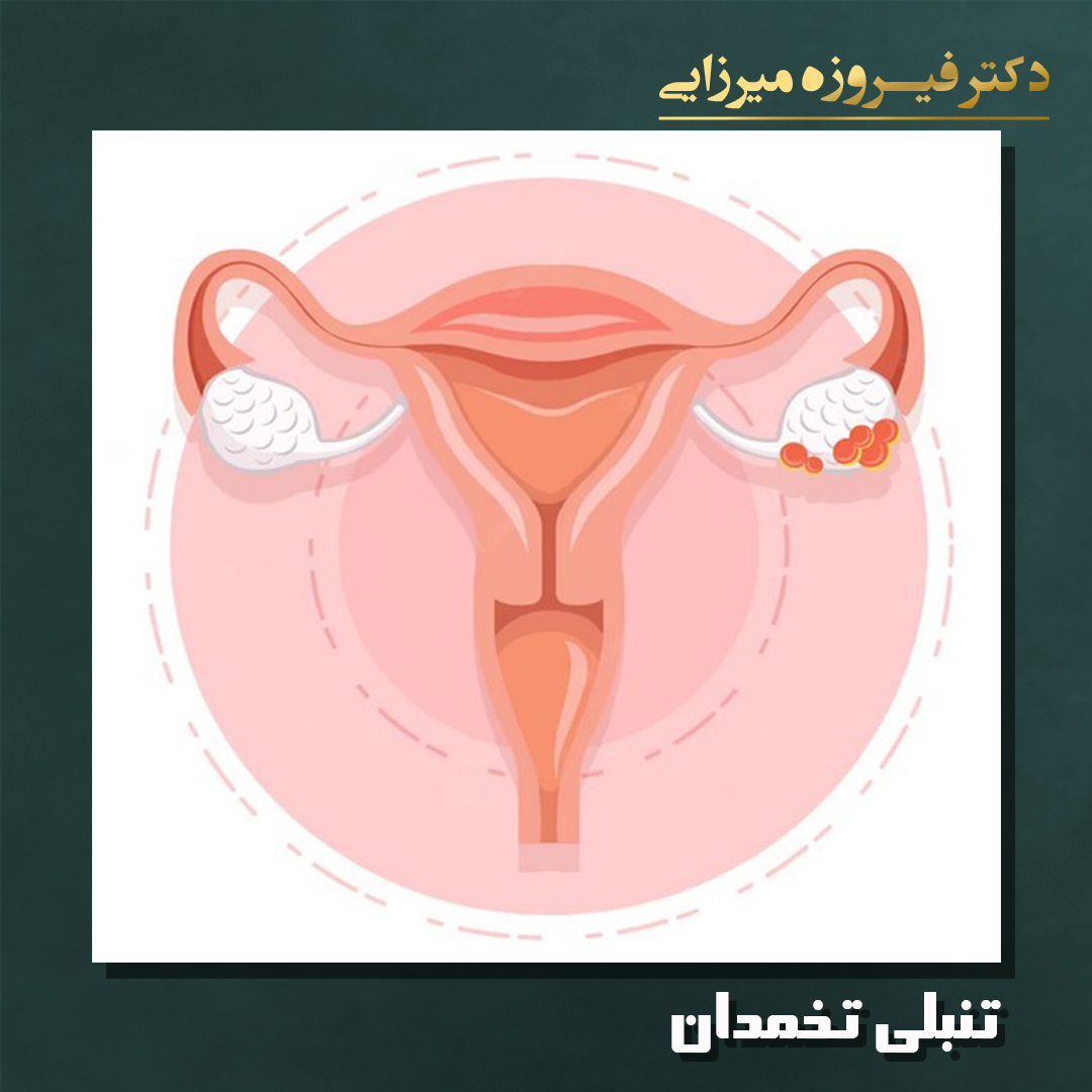تنبلی تخمدان - دکتر میرزایی