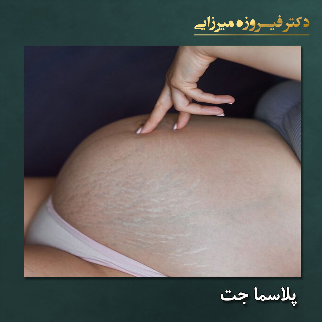 پلاسما جت - دکتر فیروزه میرزایی