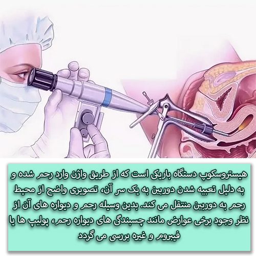 هیستروسکوپی - دکتر میرزایی