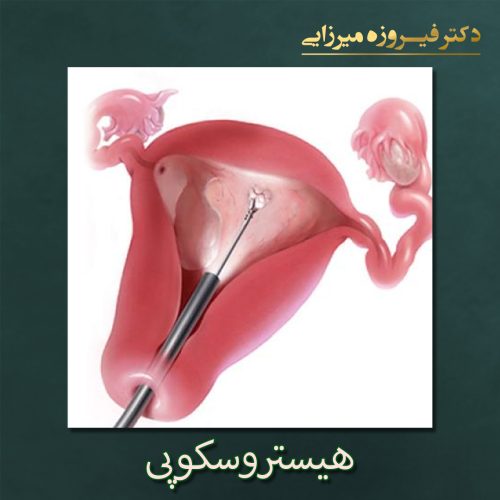 هیستروسکوپی - دکتر فیروزه میرزایی