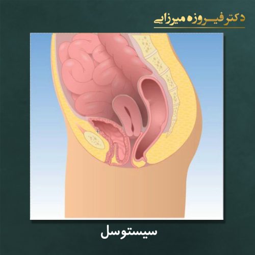 سیستوسل - دکتر میرزایی