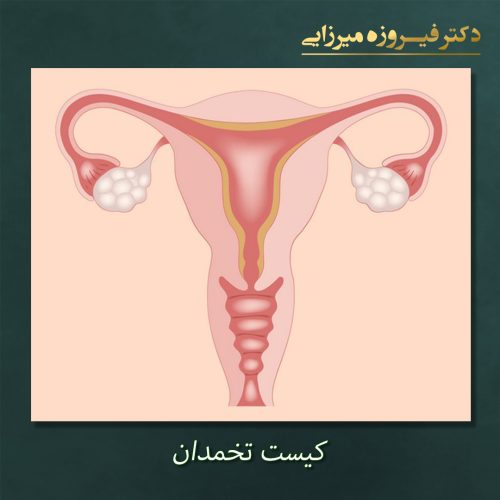 کیست تخمدان - دکتر فیروزه میرزایی